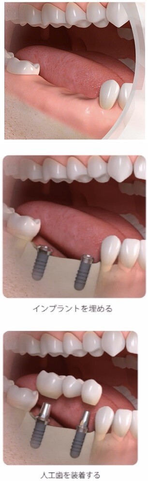 川上歯科あべの診療所 義歯とインプラントの比較