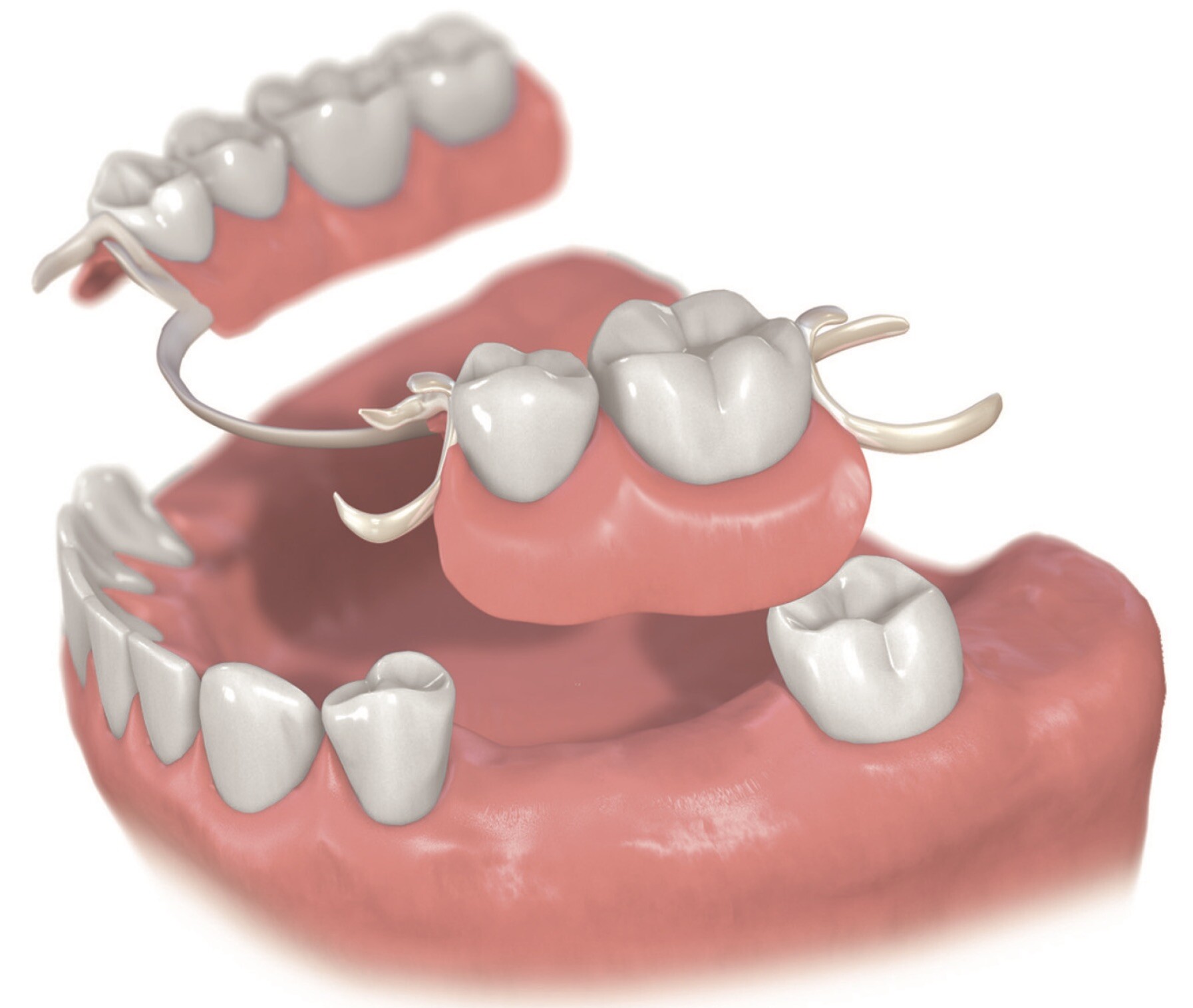 川上歯科あべの診療所 義歯とは？